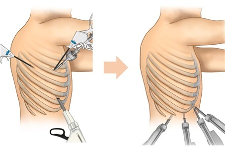 '수술 후 통증 줄인' 로봇 폐암 수술법, 안전성·효과성 입증
