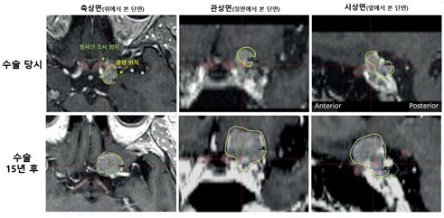 '시신경' 부작용 피하려다…수막종 자라나 시력 잃고 생존율도 '뚝'