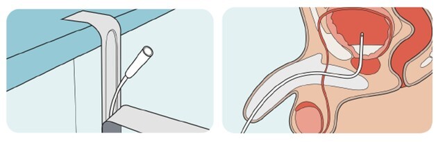 소변 참기 힘들고 자주 샌다면…"'신경인성 방광' 의심"