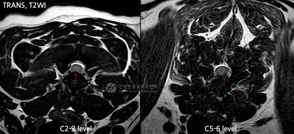 본문 이미지 - 사지마비 증상을 보인 환견의 MRI 영상. 경추 2~3번(C2-3) 부위에서 신경 압박이 확인됐고, 특히 경추 5~6번(C5-6) 부위에서는 디스크가 한쪽으로 심하게 탈출하며 척수를 강하게 누르고 있었(본동물의료센터 제공). ⓒ 뉴스1