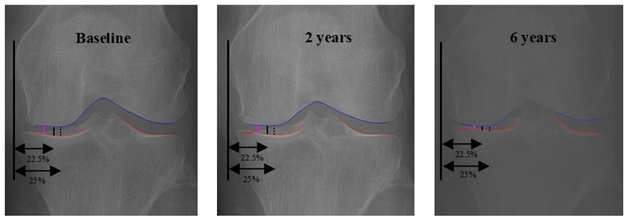 "AI로 무릎 골관절염 최대 마모 지점 정밀하게 찾아낼 수 있다"