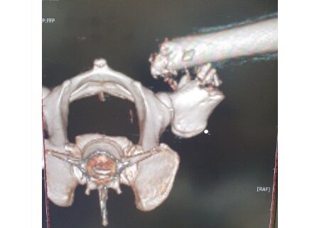 본문 이미지 - 골육종으로 부러진 다리 CT 사진(코난 아빠 제공) ⓒ 뉴스1
