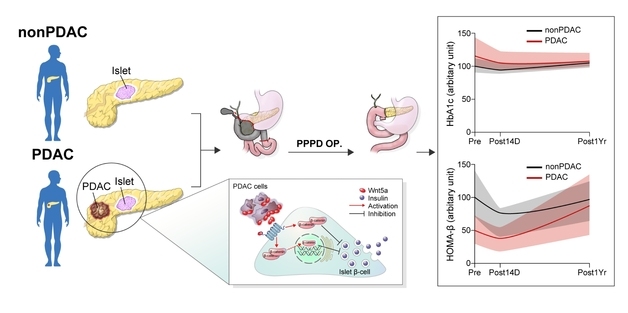 "이유 없는 갑작스런 당뇨, 췌장암의 경고 신호일 수도"