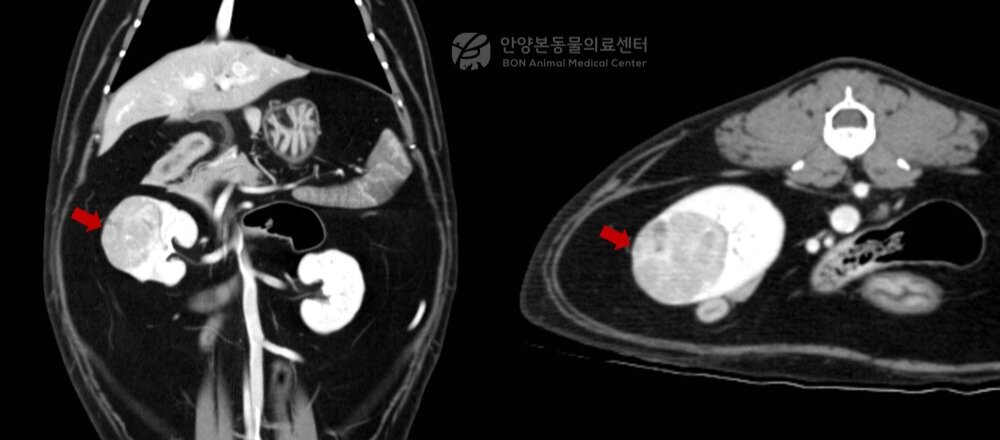 본문 이미지 - 수술 전 정밀 평가를 위한 신장 CT 검사 결과 2.2x2.2x3.0㎝ 크기 종괴가 확인됐다(병원 제공). ⓒ 뉴스1