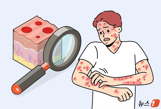 수두 환자 일주일 새 23%↑…"발진 발생 후 최소 5일은 격리해야"