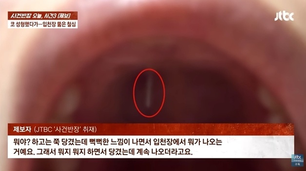 코에 박은 철심이 입천장 뚫고 나왔는데…병원 "제거하면 그만"