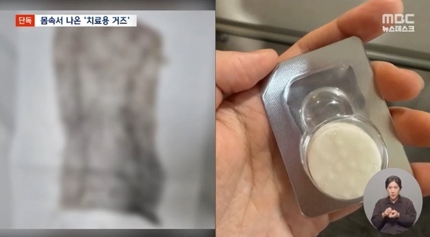 자궁 시술 후 손바닥만 한 거즈가 몸속에…제거 안 한 의사는 '무혐의'