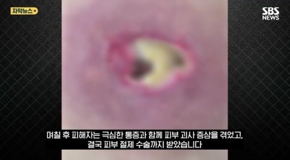 마사지숍서 잠든 새 맘대로 '점 제거'…피부 괴사 돼 절제 수술 '분통'