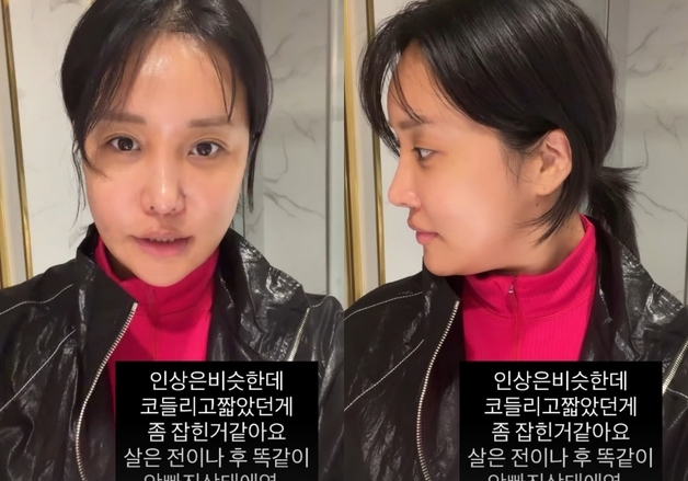 "잘 자리잡았다" 랄랄, 코 재성형 후 만족…더욱 날렵해진 콧날 [N샷]