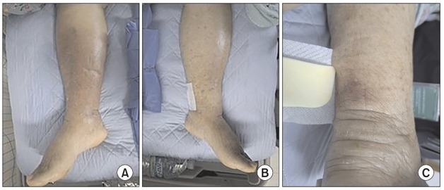 "냉동 바지락 끓여 먹었는데"…'치명률 50%' 비브리오패혈증 감염