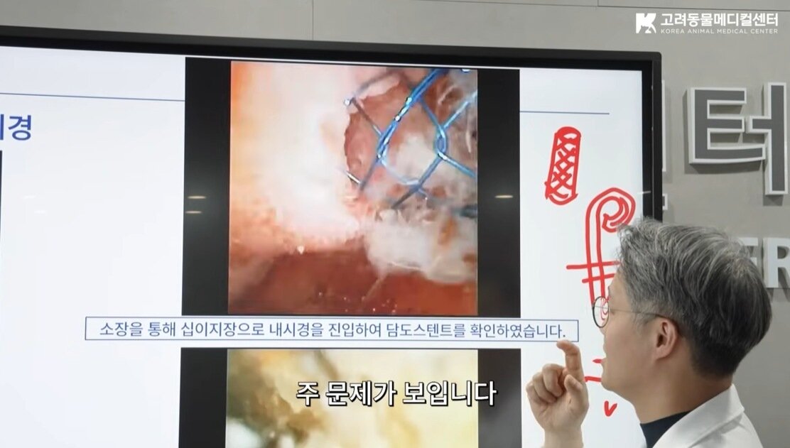 본문 이미지 - 좁아진 담도를 확보하기 위해 삽입한 금속 스텐트가 막혀 진행한 내시경 과정을 설명하는 이선태 센터장(유튜브 갈무리) ⓒ 뉴스1