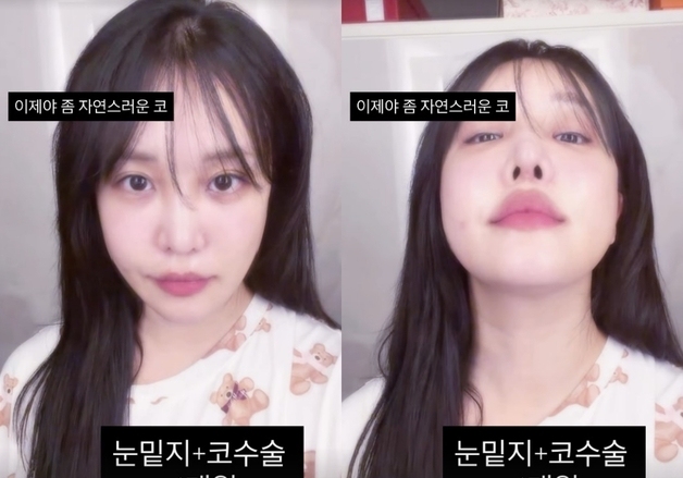 "눈밑지·코수술 1개월"…랄랄, 성형 후 물오른 비주얼