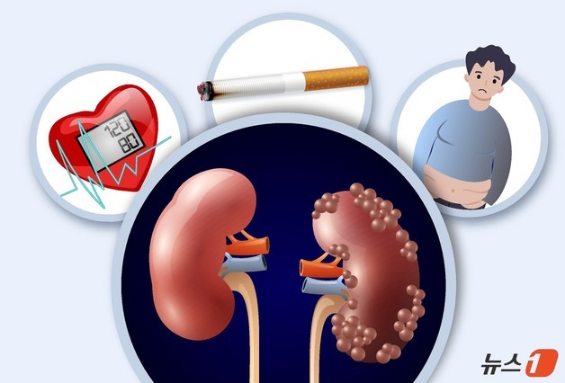 [100세건강] 초기 증상 없는 신장암…흡연자 주의, 건강검진 중요
