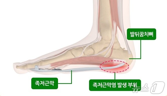 본문 이미지 - 족저근막의 위치. (질병관리청 제공)