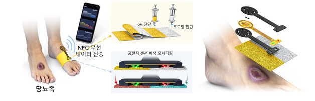 당뇨발 상처 눈으로 실시간 확인하는 스마트 패치 개발