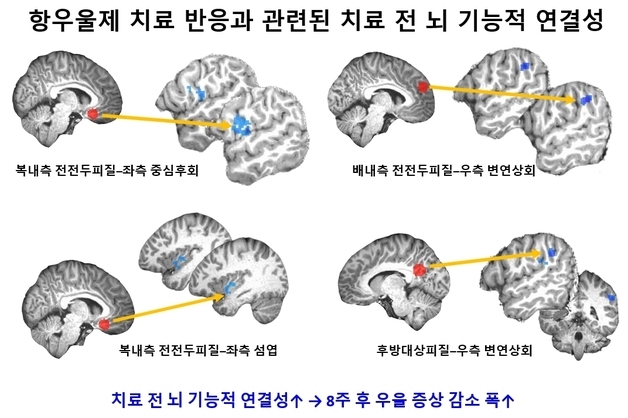 청소년 우울증 약물 치료 효과, 치료 전 뇌 MRI로 예측 가능