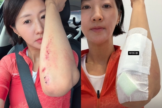 손문선, 자전거 타다 내리막길서 아찔 부상…"무릎 패이고 팔꿈치 갈려"