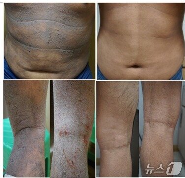 본문 이미지 - 중증아토피피부염 환자의 치료 경과 사진. (한림대의료원 제공)