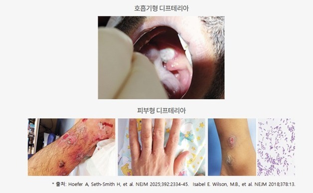 호주 디프테리아 30배 급증…"의심 환자 즉시 신고" 유입 촉각
