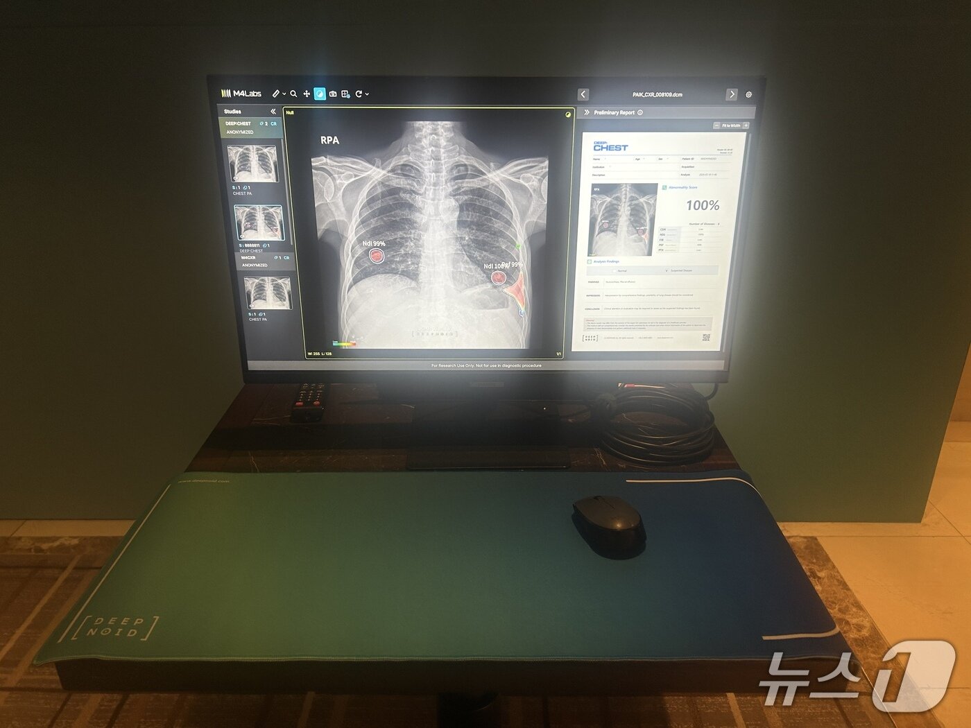 본문 이미지 - 흉부 X-ray 영상에서 폐질환 의심부위를 검출해 의료진의 판독을 보조하는 딥체스트. 2026.7.13 ⓒ 뉴스1 문대현 기자 