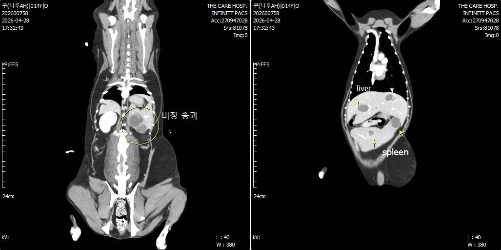 본문 이미지 - CT로 확인한 비장 종괴(인쪽) 사진과 간의 다바성 결절성 병변이 확인된 모습 ⓒ 뉴스1