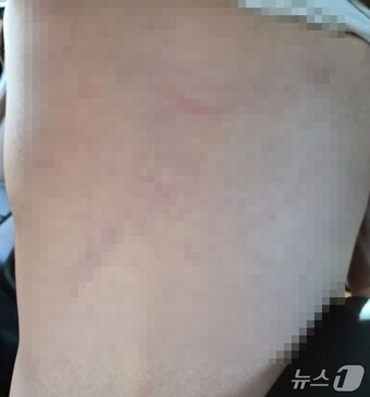 본문 이미지 - 대구 달서구 장애 전담 어린이집 아동학대 피해 아동의 등 사진(독자 제공)