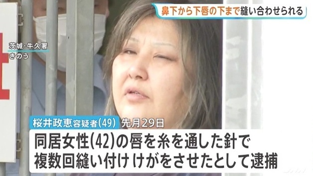 바늘과 실로 입을 정말 꿰맬 수 있어?…여성이 여성을, 일본서 실제 발생