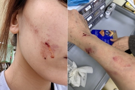 "교사 아이에 물리고 머리 다쳐 뇌진탕인데…보호자는 '학대' 신고"