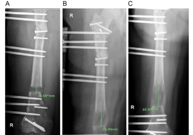 How Novosis is Revolutionizing Bone Healing for Difficult Fractures: A Case Study
