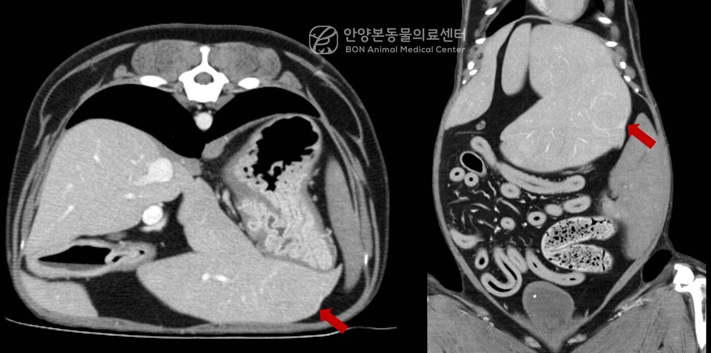본문 이미지 - CT 검사로 확인한 간 종괴(병원 제공) ⓒ 뉴스1