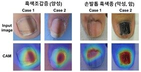 본문 이미지 - 흑색조갑증에 비해 손발톱 흑색종은 빠르게 넓어지거나 진해지는 경우가 많으며 손톱 주변의 피부까지 퍼지는 양상을 보인다. 아래쪽 사진들은 AI가 두 가지를 구분하는 데에 중요한 부분을 활성화(Class Activation Map)한 모습을 보여주고 있다. (세브란스병원 제공)