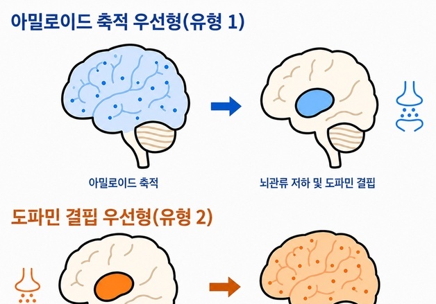 루이소체치매, 진행 경로 두가지로 나뉜다…"맞춤형 치료 추진"