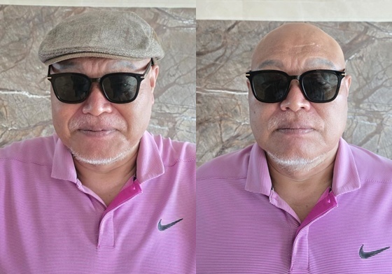 김흥국 "스트레스로 머리 다 빠져"…탈모 치료제 모델로 인생 2막 연다