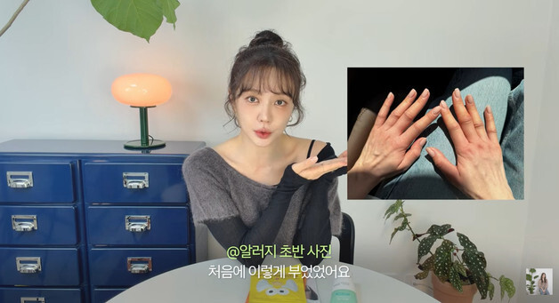 윤은혜, 퉁퉁 부은 손 '깜짝'? "심각한 알레르기로 2주 동안 링거 치료"